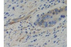 Detection of WARS in Human Prostate cancer Tissue using Polyclonal Antibody to Tryptophanyl tRNA Synthetase (WARS) (WARS 抗体  (AA 247-458))