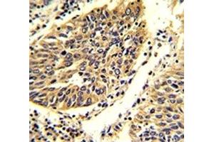 IHC analysis of FFPE human lung carcinoma stained with WNT4 antibody. (WNT4 抗体  (AA 242-269))