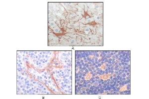 Immunohistochemical analysis of paraffin-embedded human cerebrum tumor (A), endothelium of vessel (B), lymphocyte of thymus(C), showing cytoplasmic localization using FES antibody with DAB staining. (FES 抗体)