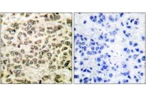 Immunohistochemistry analysis of paraffin-embedded human breast carcinoma tissue, using HDAC3 Antibody. (HDAC3 抗体  (AA 379-428))