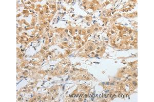 Immunohistochemistry of Human lung cancer using BPIFB2 Polyclonal Antibody at dilution of 1:45 (BPIL1 抗体)