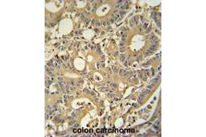 TPSD1 antibody (C-term) immunohistochemistry analysis in formalin fixed and paraffin embedded human colon carcinoma followed by peroxidase conjugation of the secondary antibody and DAB staining. (TPSD1 抗体  (C-Term))