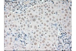 Immunohistochemical staining of paraffin-embedded liver tissue using anti-VEGFmouse monoclonal antibody.