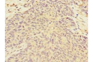 Immunohistochemistry of paraffin-embedded human ovarian cancer using ABIN7149955 at dilution of 1:100 (FMO2 抗体  (AA 210-470))