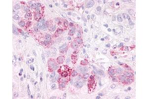 Anti-GPR3 antibody IHC of human Ovary, Carcinoma. (GPR3 抗体  (Extracellular Domain))