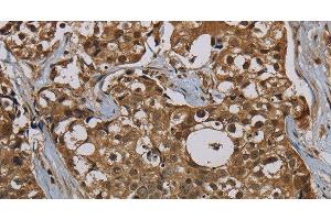 Immunohistochemistry of paraffin-embedded Human breast cancer tissue using PNN Polyclonal Antibody at dilution 1:50 (PNN 抗体)