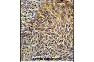 ANKRD32 Antibody (N-term) (ABIN651599 and ABIN2840316) immunohistochemistry analysis in formalin fixed and paraffin embedded human cervix carcinoma followed by peroxidase conjugation of the secondary antibody and DAB staining.