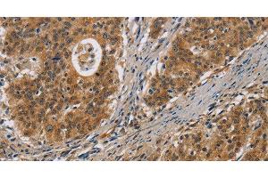 Immunohistochemistry of paraffin-embedded Human gastric cancer tissue using IL17D Polyclonal Antibody at dilution 1:50 (IL17D 抗体)