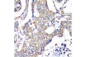 Immunohistochemistry of paraffin-embedded Human colon carcinoma using TXNDC9 Rabbit pAb  at dilution of 1:100 (40x lens).