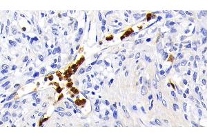 Detection of CASP1 in Human Ovarian cancer Tissue using Polyclonal Antibody to Caspase 1 (CASP1) (Caspase 1 抗体  (AA 120-297))
