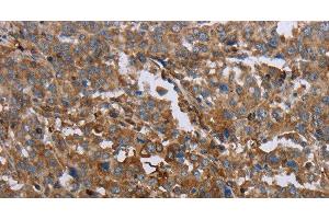 Immunohistochemistry of paraffin-embedded Human liver cancer using GCK Polyclonal Antibody at dilution of 1:40 (GCK 抗体)