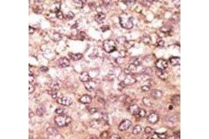 IHC analysis of FFPE human hepatocarcinoma tissue stained with the anti-ATG5 antibody (ATG5 抗体  (AA 209-238))