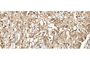 Immunohistochemistry of paraffin-embedded Human lung cancer tissue using CHFR Polyclonal Antibody at dilution of 1:35(x200)