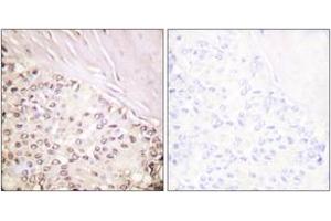 Immunohistochemistry analysis of paraffin-embedded human breast carcinoma tissue, using FANCD2 (Ab-222) Antibody. (FANCD2 抗体  (AA 188-237))