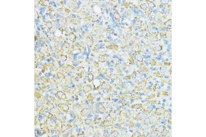 Immunohistochemistry of paraffin-embedded human mammary cancer using SOD3 antibody (ABIN6128740, ABIN6148276, ABIN6148278 and ABIN6222746) at dilution of 1:100 (40x lens). (SOD3 抗体  (AA 19-160))