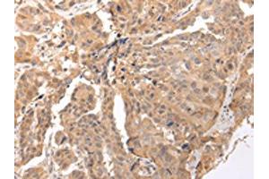 The image on the left is immunohistochemistry of paraffin-embedded Human breast cancer tissue using ABIN7190290(CLDND2 Antibody) at dilution 1/45, on the right is treated with synthetic peptide. (CLDND2 抗体)