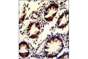 Formalin-fixed and paraffin-embedded human colon carcinoma with KLF4 Antibody, which was peroxidase-conjugated to the secondary antibody, followed by DAB staining. (KLF4 抗体)