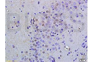 Formalin-fixed and paraffin embedded human colorectal cancer labeled with Anti OCT4B-190 Polyclonal Antibody, Unconjugated (ABIN704531) at 1:200 followed by conjugation to the secondary antibody and DAB staining (Oct-4BOCT4B-190NT (AA 201-300) 抗体)