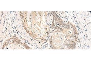 Immunohistochemistry of paraffin-embedded Human esophagus cancer tissue using DPPA4 Polyclonal Antibody at dilution of 1:55(x200) (DPPA4 抗体)