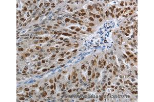 Immunohistochemistry of Human ovarian cancer using MCM3 Polyclonal Antibody at dilution of 1:30 (MCM3 抗体)