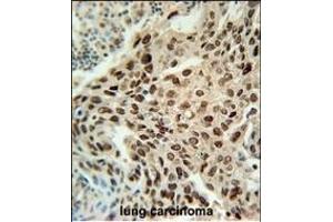 PRNIP Antibody (C-term) (ABIN651984 and ABIN2840482) immunohistochemistry analysis in formalin fixed and paraffin embedded human lung carcinoma followed by peroxidase conjugation of the secondary antibody and DAB staining. (ERI3 抗体  (C-Term))