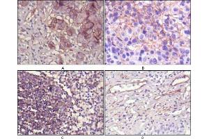 Immunohistochemical analysis of paraffin-embedded human lung cancer (A), cholangiocarcinorna (B), lymph node (C) and esophagus (D) tissues using NT5E mouse mAb with DAB staining. (CD73 抗体)