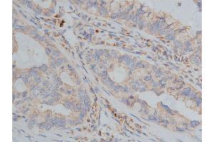 ABIN6268647 at 1/200 staining human lung cancer tissue sections by IHC-P. (TSC1 抗体  (C-Term))
