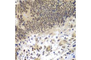 Immunohistochemistry of paraffin-embedded human colon carcinoma using CEBPG antibody.