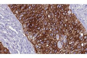 ABIN6268995 at 1/100 staining Human urothelial cancer tissue by IHC-P. (TGFBR2 抗体  (Internal Region))