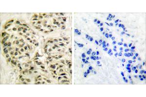 Peptide - +Immunohistochemical analysis of paraffin-embedded human breast carcinoma tissue using Cyclin-L1 antibody (#C0295). (Cyclin L1 抗体)