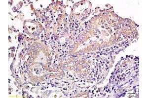 Formalin-fixed and paraffin embedded human gastric cancer labeled with Anti CD1a/Cortical thymocyte antigen CD1A Polyclonal Antibody, Unconjugated  at 1:300 followed by conjugation to the secondary antibody and DAB staining (CD1a 抗体  (AA 151-250))
