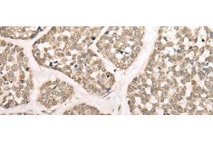 Immunohistochemistry of paraffin-embedded Human esophagus cancer tissue using CAPN15 Polyclonal Antibody at dilution of 1:50(x200) (Calpain 15/SOLH 抗体)