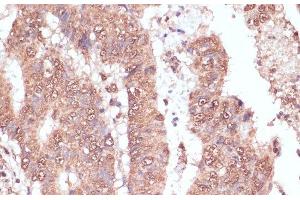 Immunohistochemistry of paraffin-embedded Human colon carcinoma using RAD50 Polyclonal Antibody at dilution of 1:100 (40x lens). (RAD50 抗体)