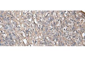 Immunohistochemistry of paraffin-embedded Human lung cancer tissue using NDUFB5 Polyclonal Antibody at dilution of 1:45(x200) (NDUFB5 抗体)