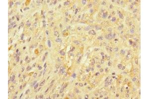 Immunohistochemistry of paraffin-embedded human melanoma using ABIN7174484 at dilution of 1:100 (UBE2S 抗体  (AA 1-222))