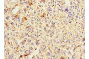 Immunohistochemistry of paraffin-embedded human melanoma using ABIN7151292 at dilution of 1:100 (TRIP12 抗体  (AA 1-240))