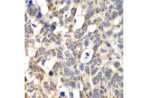 Immunohistochemistry of paraffin-embedded human esophageal cancer using PARN antibody at dilution of 1:100 (x40 lens). (PARN 抗体)