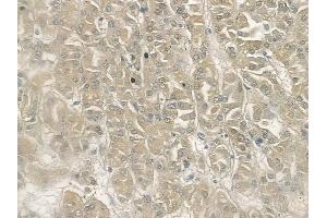 ABIN6262942 and ABIN6272945 at 1/100 staining human renal cell carcinoma by IHC-P. (LDHB 抗体  (N-Term))