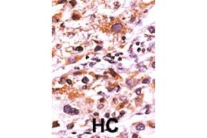 Formalin-fixed and paraffin-embedded human cancer tissue reacted with the primary antibody, which was peroxidase-conjugated to the secondary antibody, followed by AEC staining. (FGFR (pTyr766) 抗体)