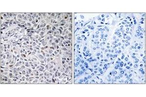 Immunohistochemistry analysis of paraffin-embedded human breast carcinoma tissue, using ZAP-70 (Ab-315) Antibody. (ZAP70 抗体  (AA 281-330))