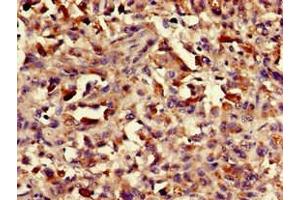 Immunohistochemistry of paraffin-embedded human melanoma using ABIN7155470 at dilution of 1:100 (ASH1L 抗体  (AA 1906-2160))