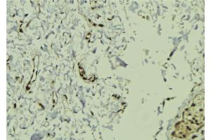 ABIN6272922 at 1/100 staining Human breast cancer tissue by IHC-P. (FERMT2 抗体  (C-Term))