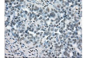 Immunohistochemical staining of paraffin-embedded colon tissue using anti-BRAFmouse monoclonal antibody. (BRAF 抗体)