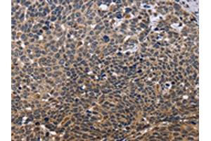 The image is immunohistochemistry of paraffin-embedded Human cervical cancer tissue using ABIN7129566(GADD45A Antibody) at dilution 1/30. (GADD45A 抗体)