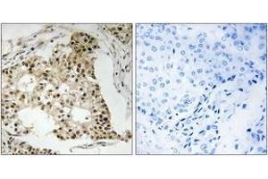 Immunohistochemistry analysis of paraffin-embedded human breast carcinoma, using Retinoic Acid Receptor alpha (Phospho-Ser77) Antibody.