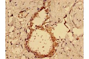 Immunohistochemistry of paraffin-embedded human ovarian cancer using ABIN7164435 at dilution of 1:100 (MKRN2 抗体  (AA 29-170))