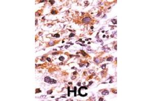 Formalin-fixed and paraffin-embedded human hepatocellular carcinoma tissue reacted with FGFR1 (phospho Y766) polyclonal antibody  which was peroxidase-conjugated to the secondary antibody followed by AEC staining. (FGFR1 抗体  (pTyr766))