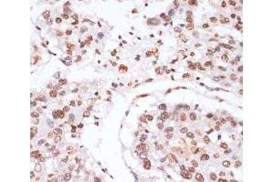 Immunohistochemistry of paraffin-embedded Human liver cancer using Phospho-Stat3(Y705) Polyclonal Antibody at dilution of 1:100 (40x lens). (STAT3 抗体  (pTyr705))
