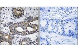 Immunohistochemistry analysis of paraffin-embedded human colon carcinoma tissue, using EIF1AY Antibody. (EIF1AY 抗体  (AA 21-70))