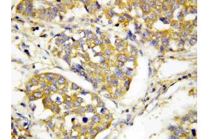 Anti-TLR4 antibody, IHC(P): Human Lung Cancer Tissue (TLR4 抗体  (N-Term))